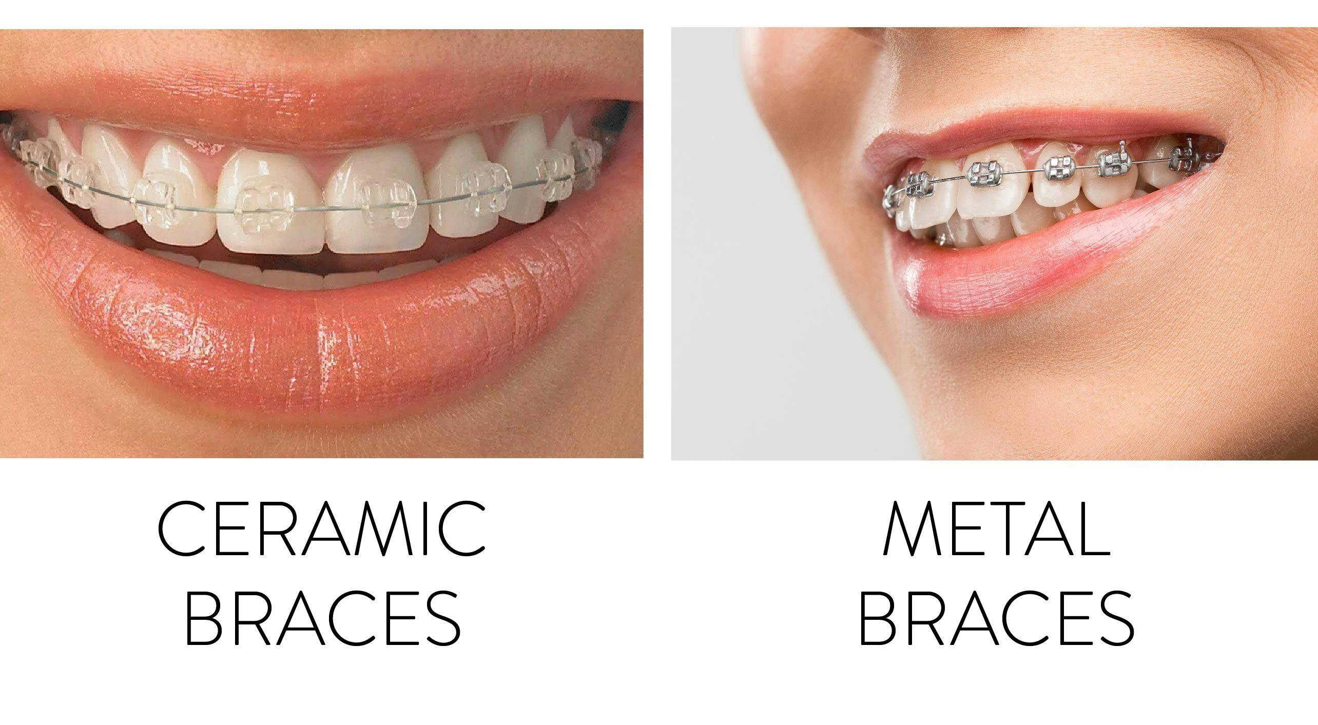 Types of Braces